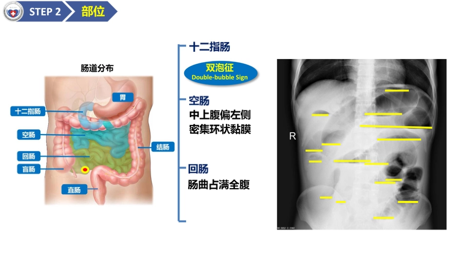 肠梗阻医学影像PPT_第12页