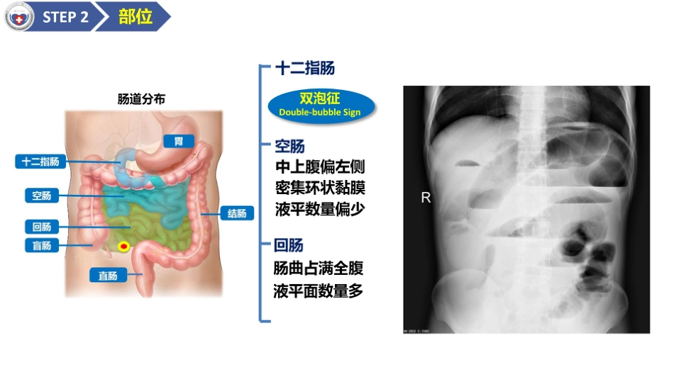 肠梗阻医学影像PPT_第13页