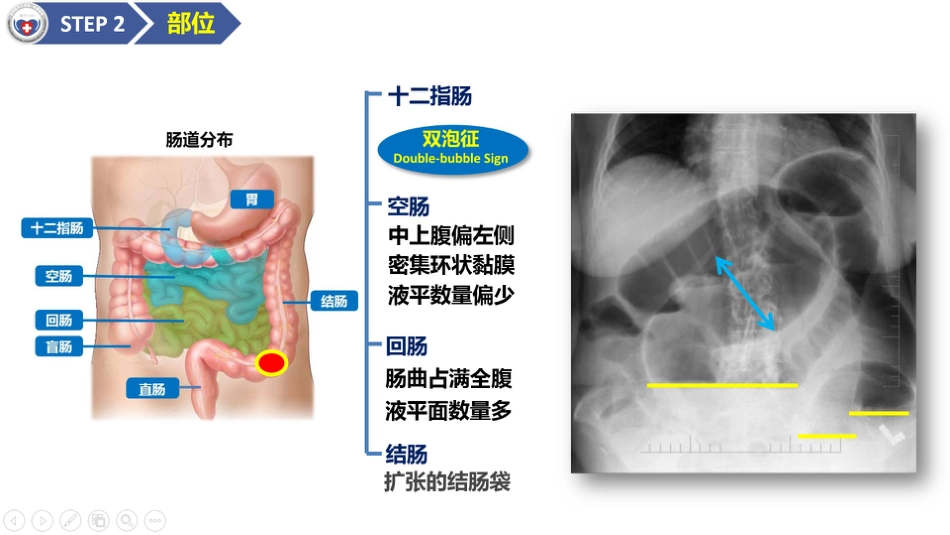 肠梗阻医学影像PPT_第14页