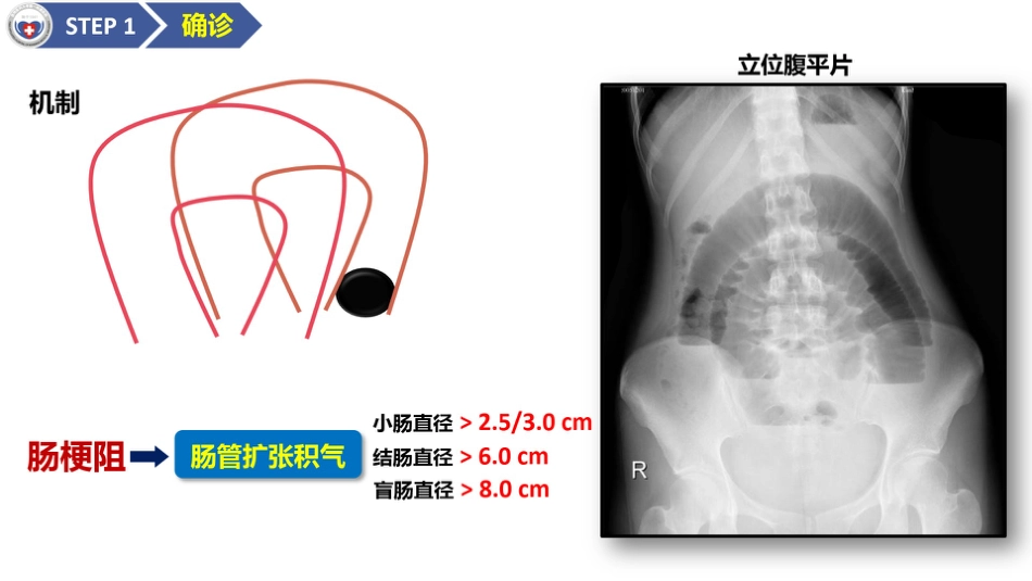 肠梗阻医学影像PPT_第4页