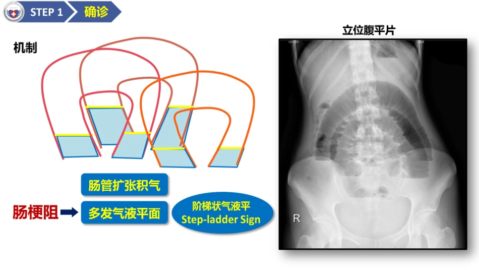 肠梗阻医学影像PPT_第5页