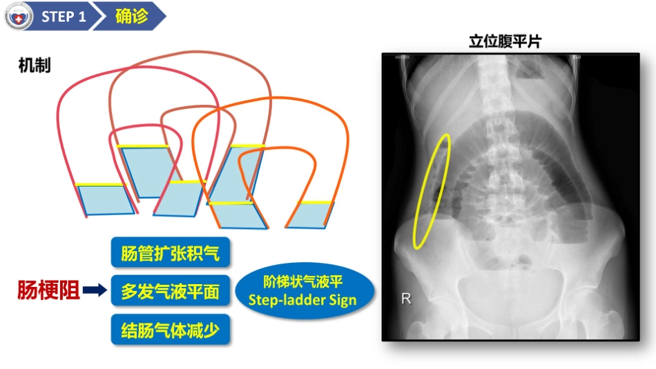 肠梗阻医学影像PPT_第6页