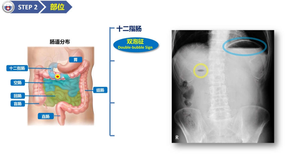 肠梗阻医学影像PPT_第8页