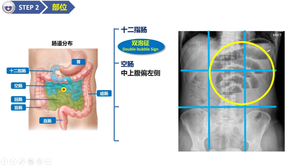 肠梗阻医学影像PPT_第9页