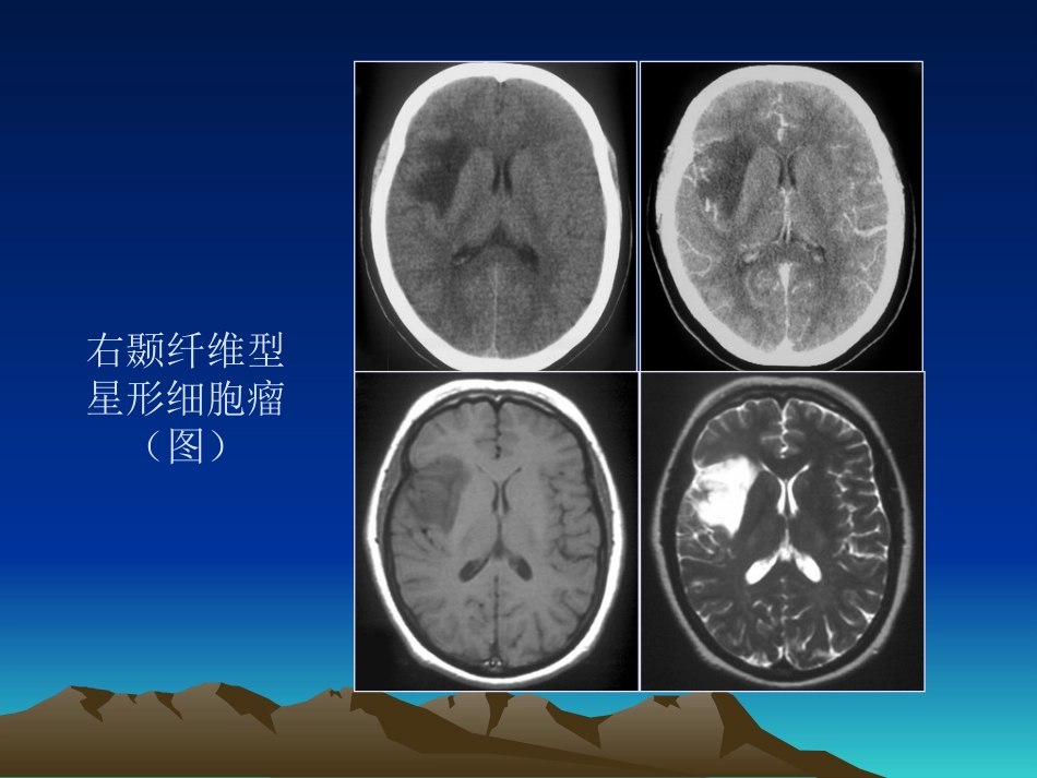 常见颅内肿瘤影像学表现_第15页