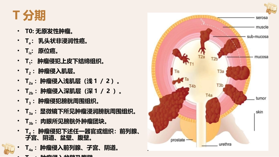 膀胱癌的影像诊断与鉴别诊断_第10页