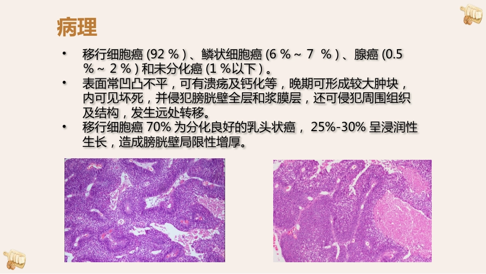 膀胱癌的影像诊断与鉴别诊断_第9页