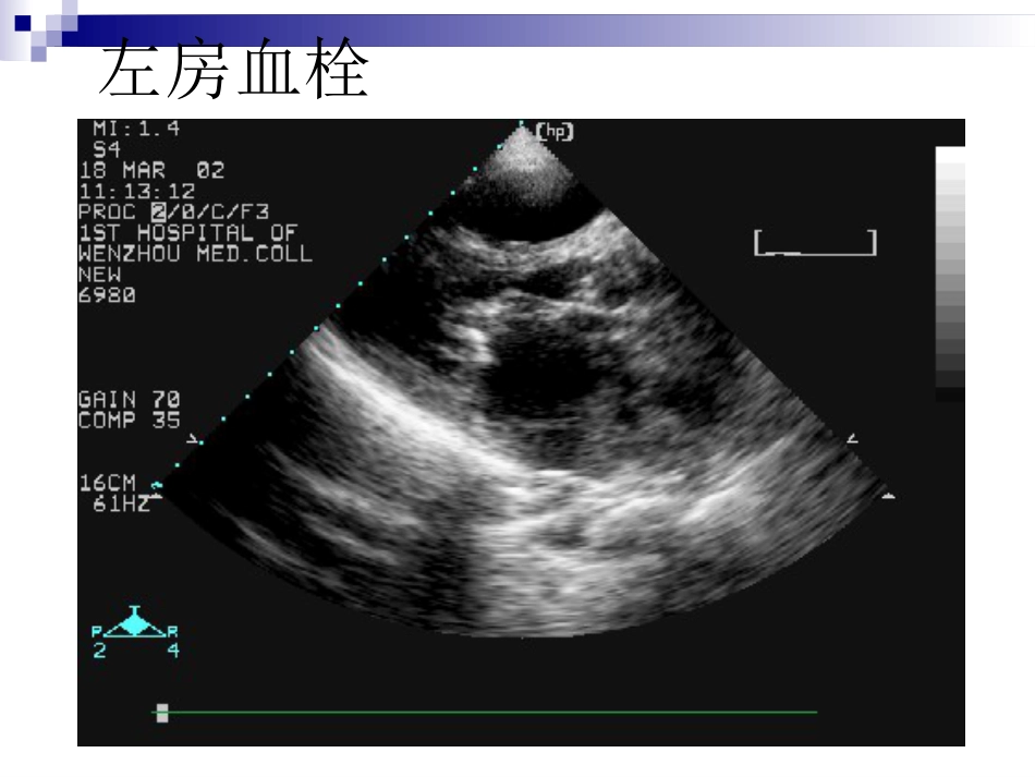 心脏瓣膜病的超声诊断课件_第11页