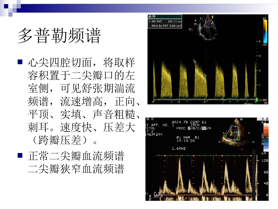心脏瓣膜病的超声诊断课件_第12页