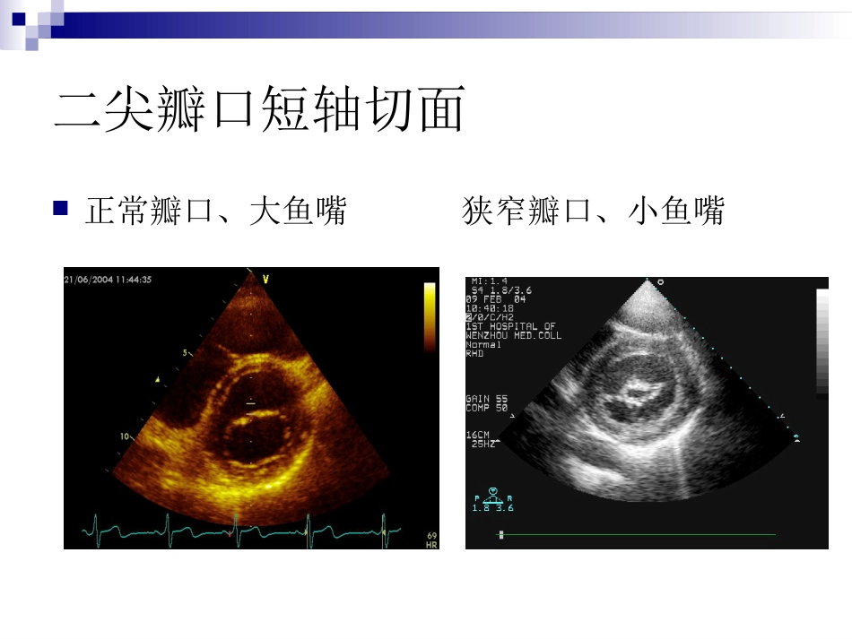 心脏瓣膜病的超声诊断课件_第6页
