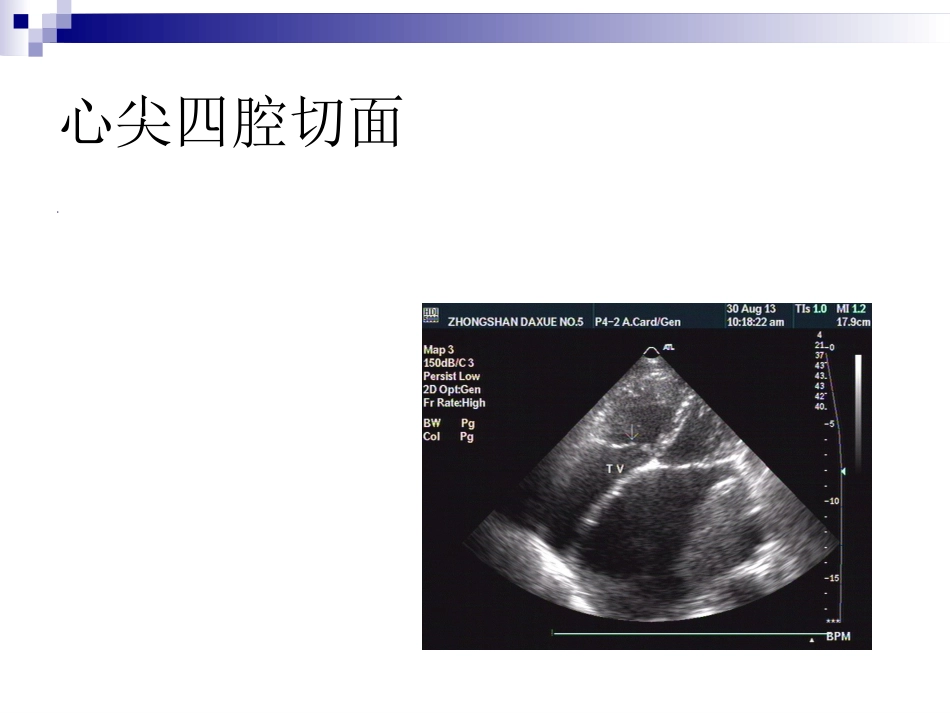 心脏瓣膜病的超声诊断课件_第9页