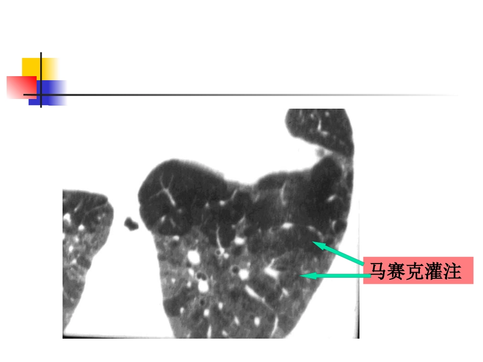 病毒性肺炎影像诊断新_第11页