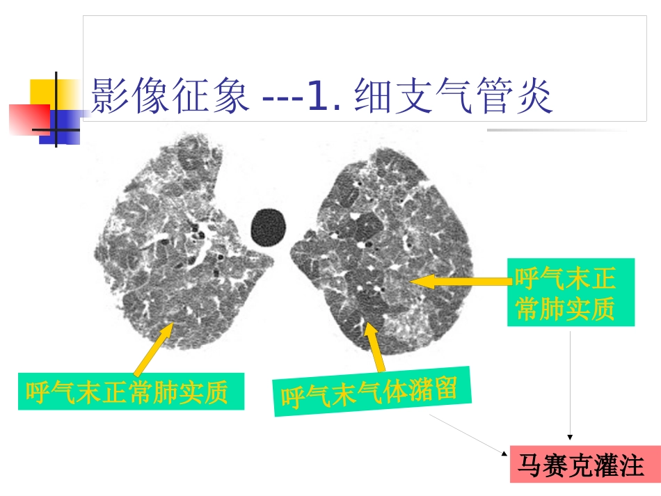 病毒性肺炎影像诊断新_第12页