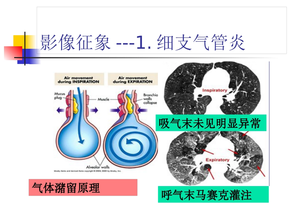 病毒性肺炎影像诊断新_第13页