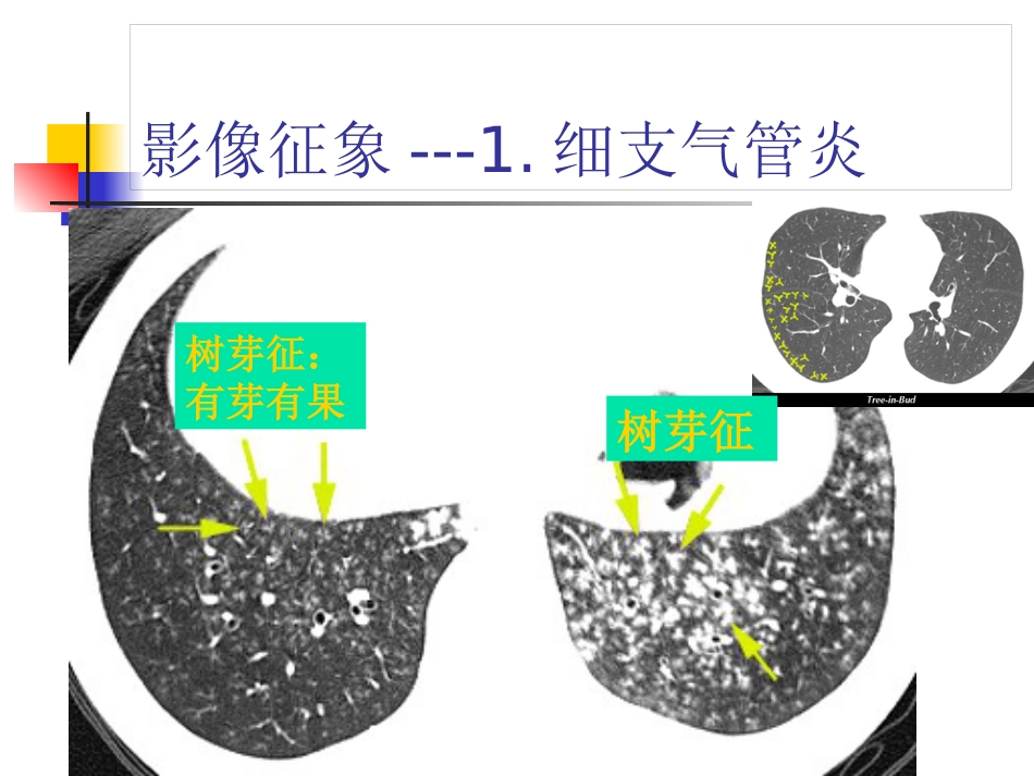 病毒性肺炎影像诊断新_第7页