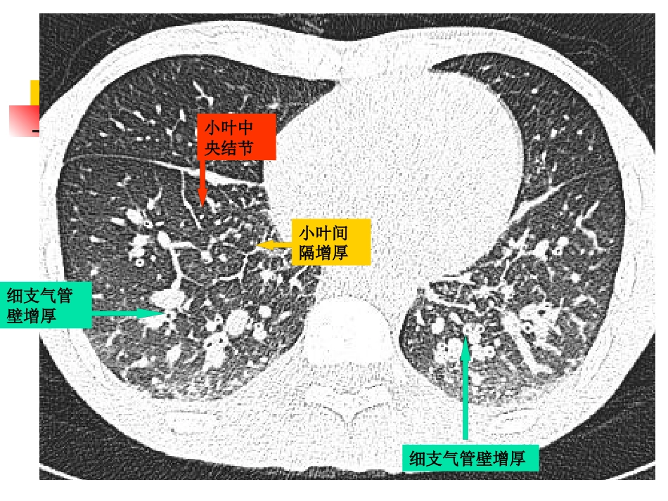 病毒性肺炎影像诊断新_第9页