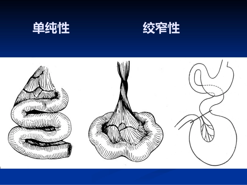 肠梗阻的分类及影像学表现(1)_第11页