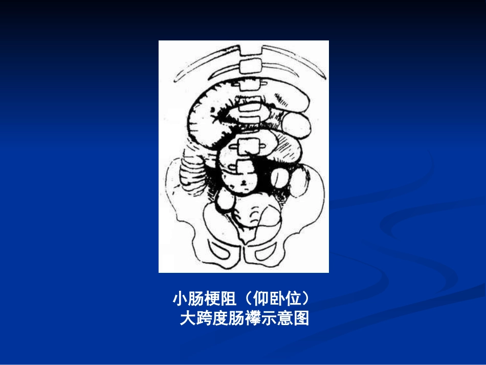 肠梗阻的分类及影像学表现(1)_第14页
