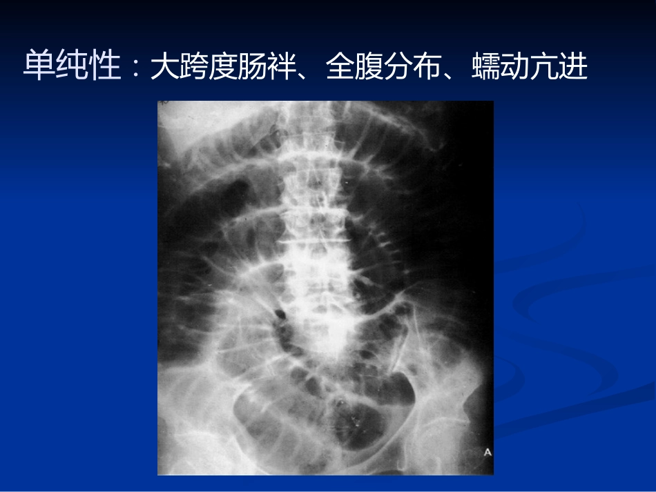 肠梗阻的分类及影像学表现(1)_第15页