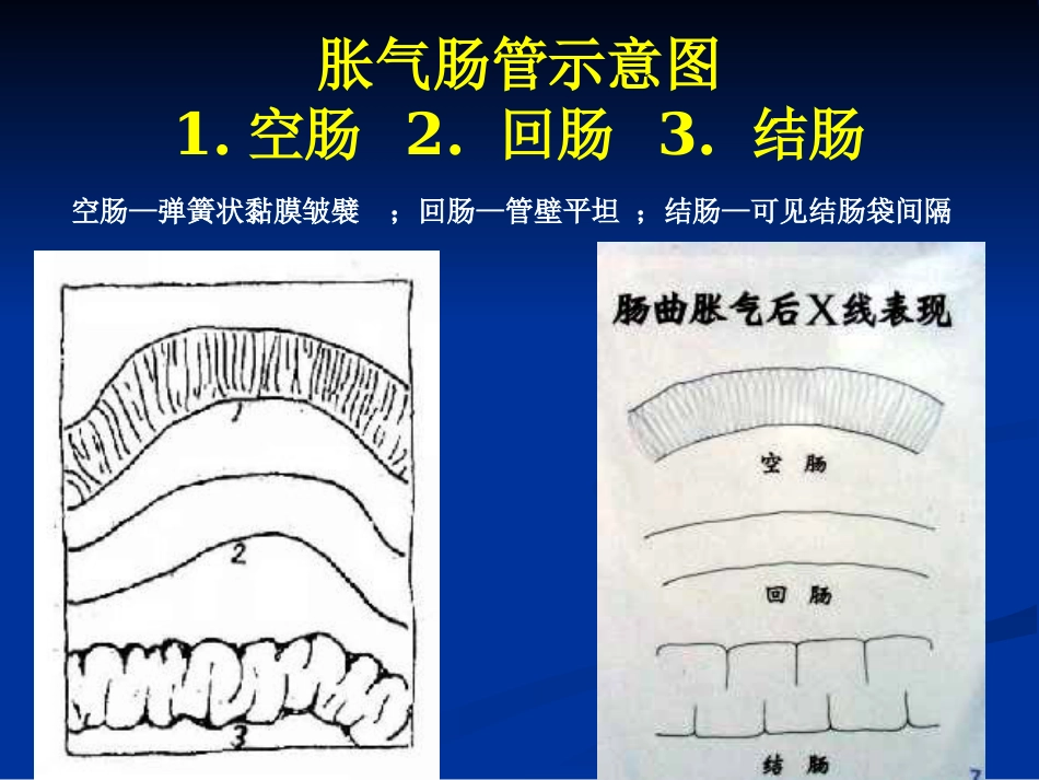 肠梗阻的分类及影像学表现(1)_第3页