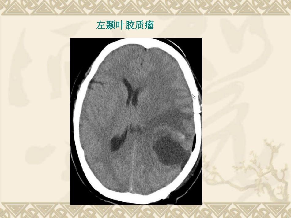 常见脑肿瘤的影像诊断(1)_第13页