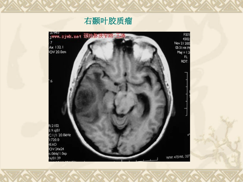 常见脑肿瘤的影像诊断(1)_第14页