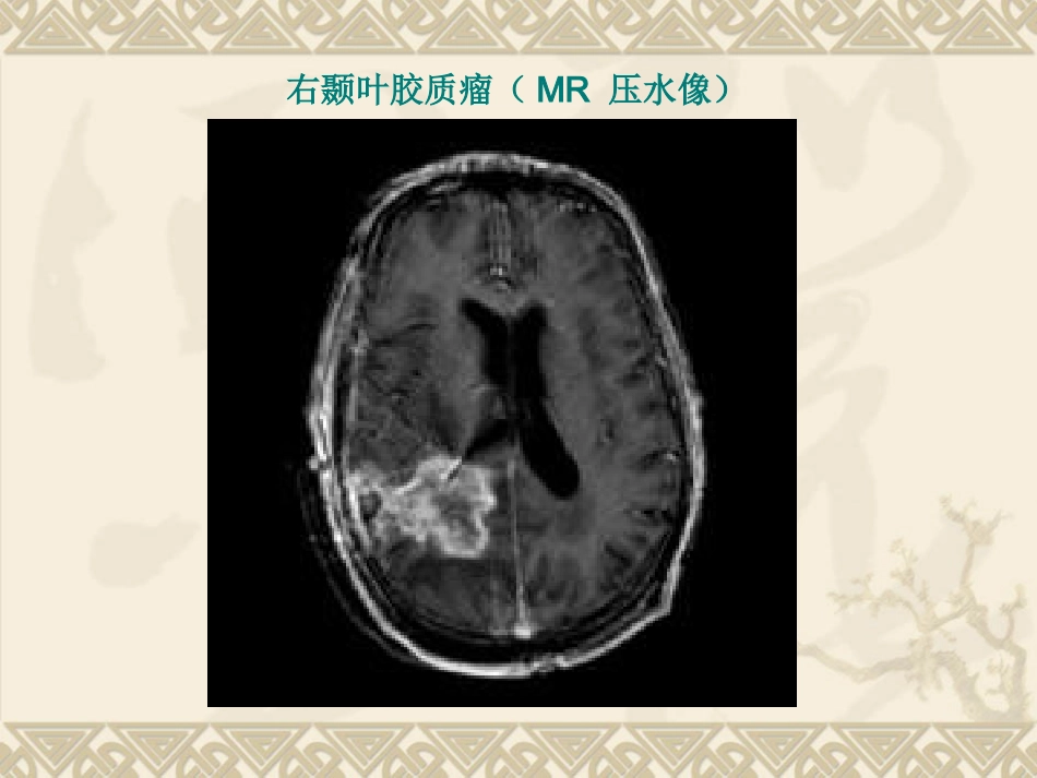 常见脑肿瘤的影像诊断(1)_第15页