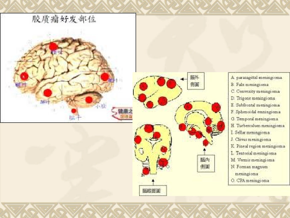 常见脑肿瘤的影像诊断(1)_第5页