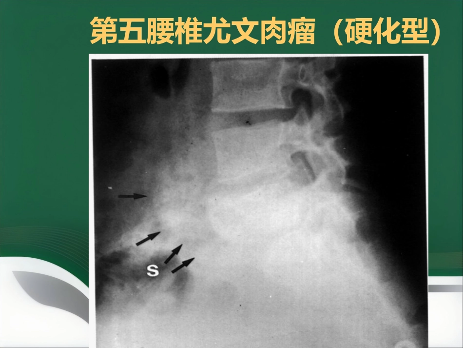 常见骨肿瘤影像诊断分析-5(其它)_第14页