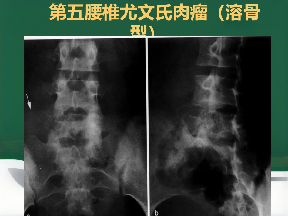 常见骨肿瘤影像诊断分析-5(其它)_第15页