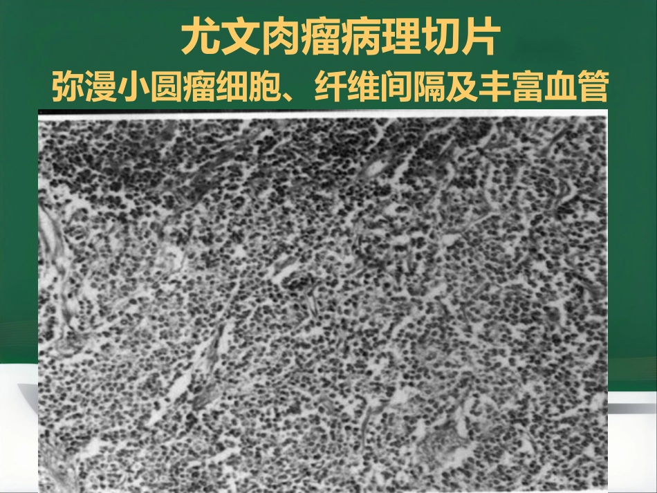 常见骨肿瘤影像诊断分析-5(其它)_第3页