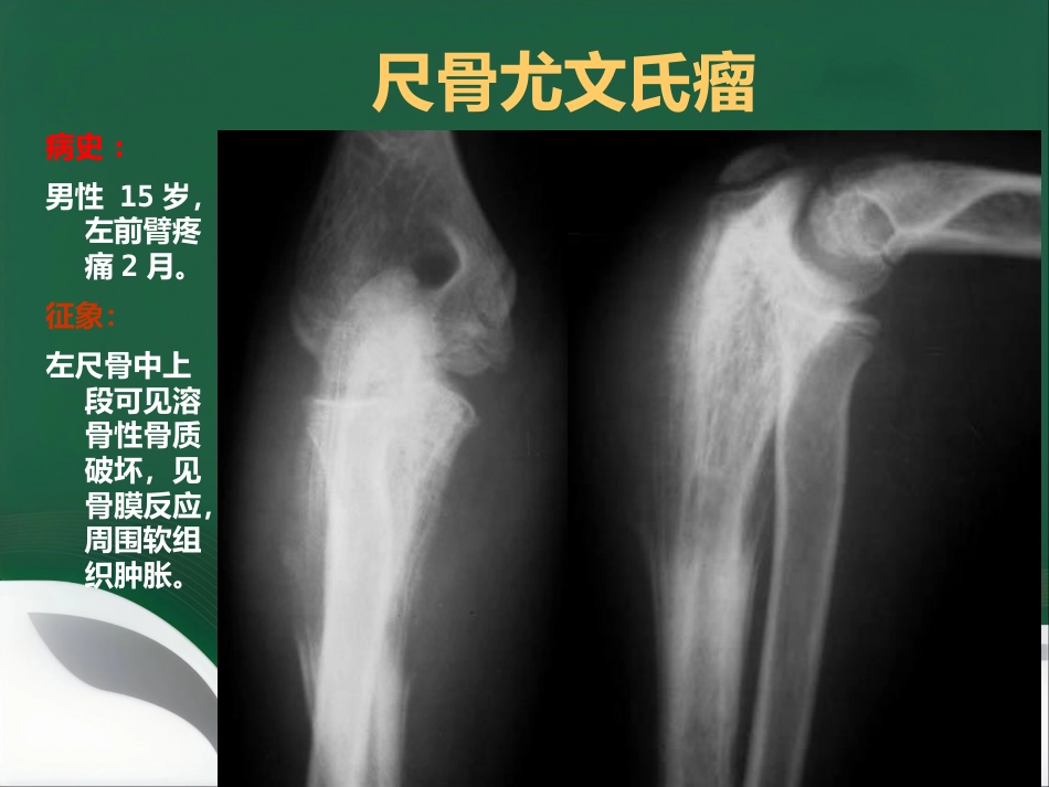 常见骨肿瘤影像诊断分析-5(其它)_第8页