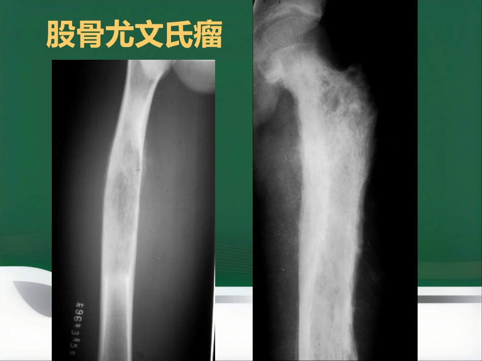 常见骨肿瘤影像诊断分析-5(其它)_第9页