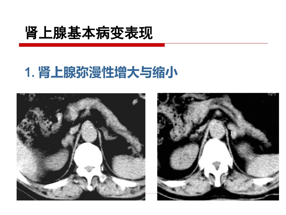 《影像诊断学》教学课件11 影像诊断学(肾上腺)_第13页