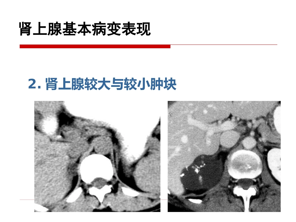 《影像诊断学》教学课件11 影像诊断学(肾上腺)_第14页