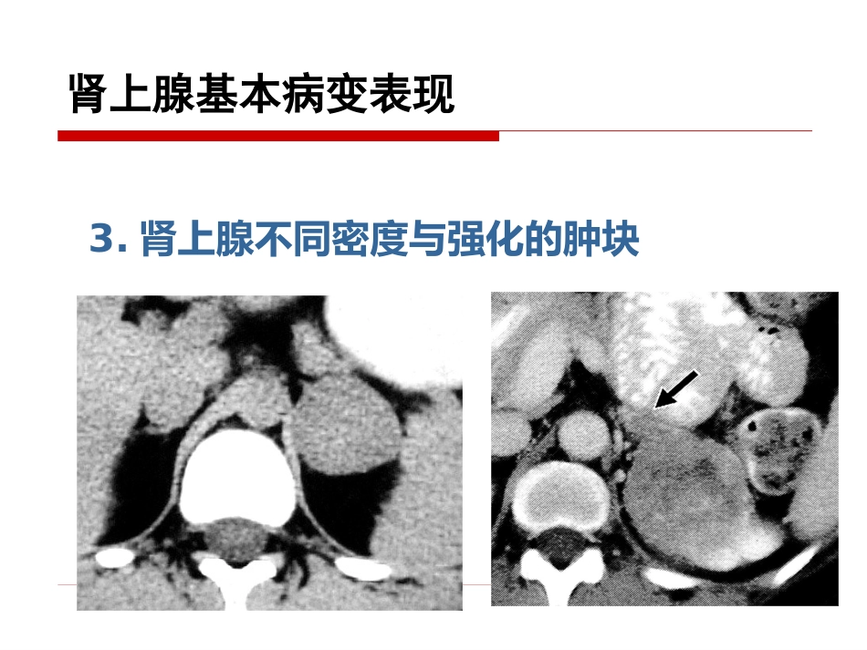 《影像诊断学》教学课件11 影像诊断学(肾上腺)_第15页