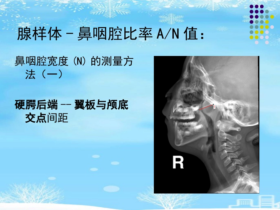 鼻咽腺样体肥大的影像诊断级2021PPT_第11页