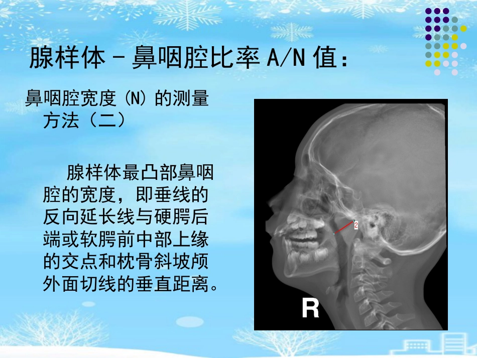 鼻咽腺样体肥大的影像诊断级2021PPT_第12页