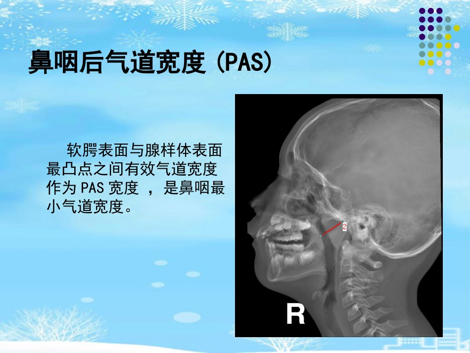 鼻咽腺样体肥大的影像诊断级2021PPT_第14页