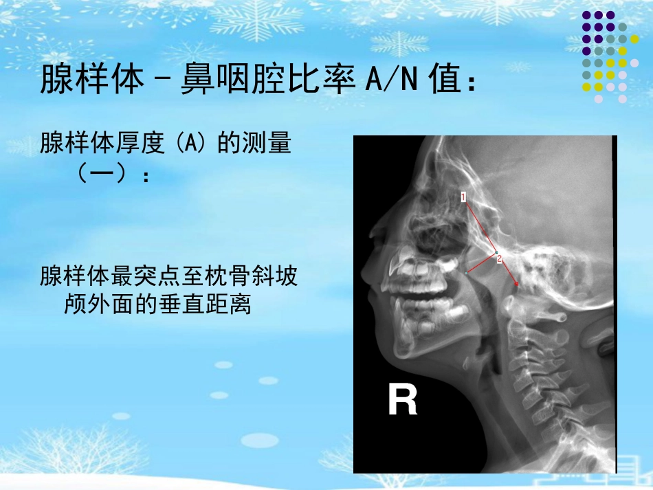 鼻咽腺样体肥大的影像诊断级2021PPT_第9页