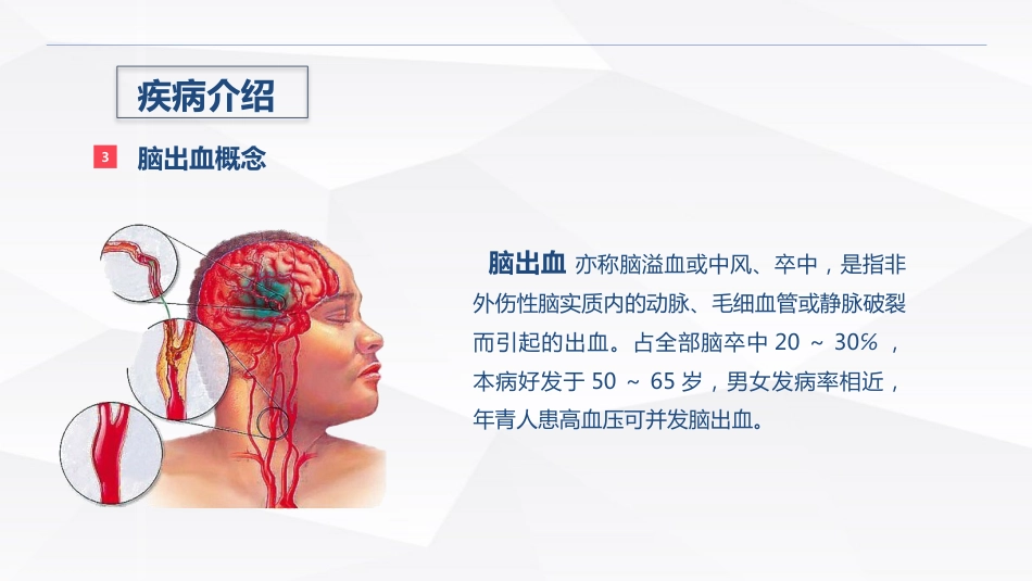 脑出血疾病介绍+术后护理_第4页