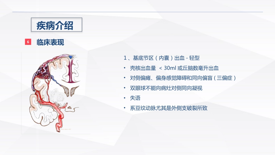 脑出血疾病介绍+术后护理_第8页