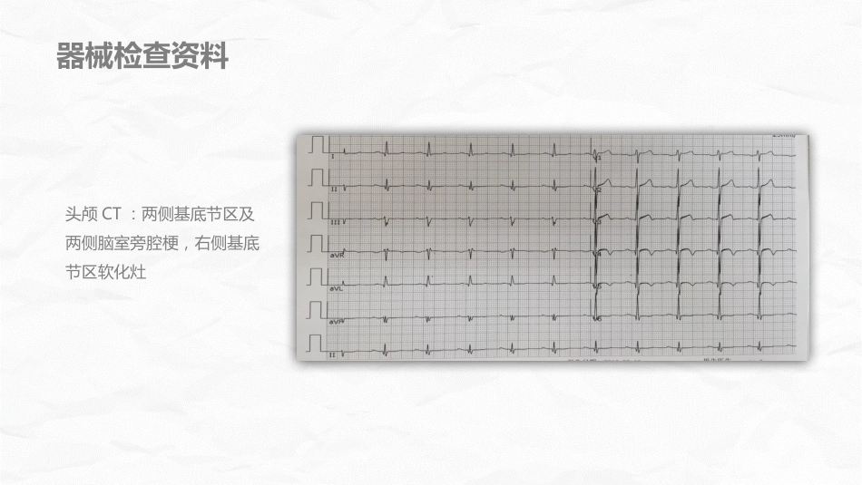 脑梗死个案护理_第10页