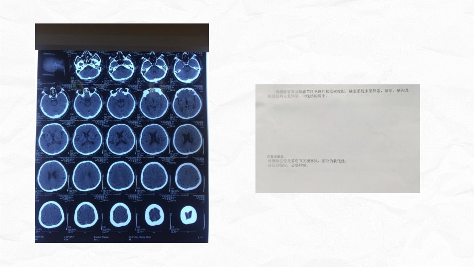 脑梗死个案护理_第12页