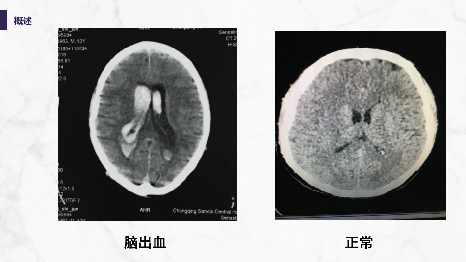 脑室引流管的护理_第10页