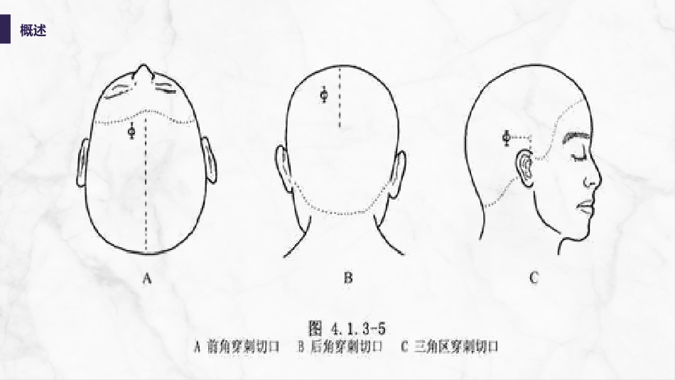 脑室引流管的护理_第6页