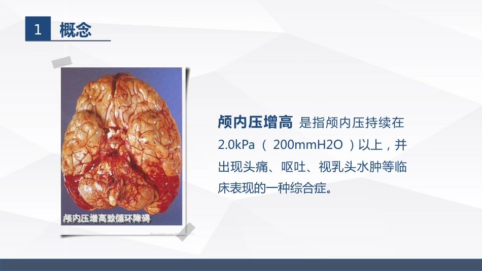 颅内压增高病人的护理_第5页