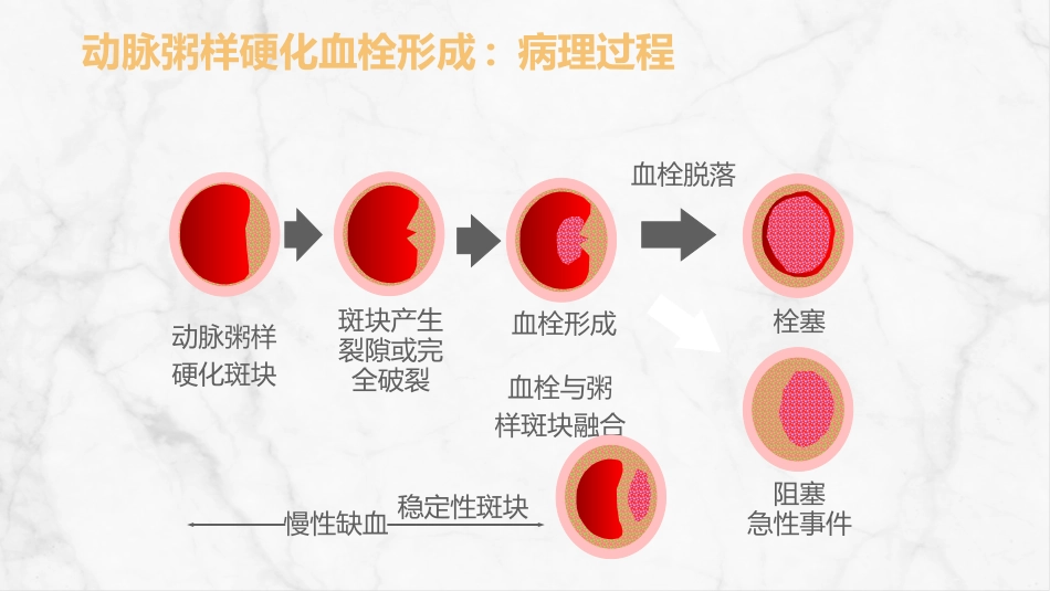急性脑梗死的溶栓及抗栓治疗_第5页