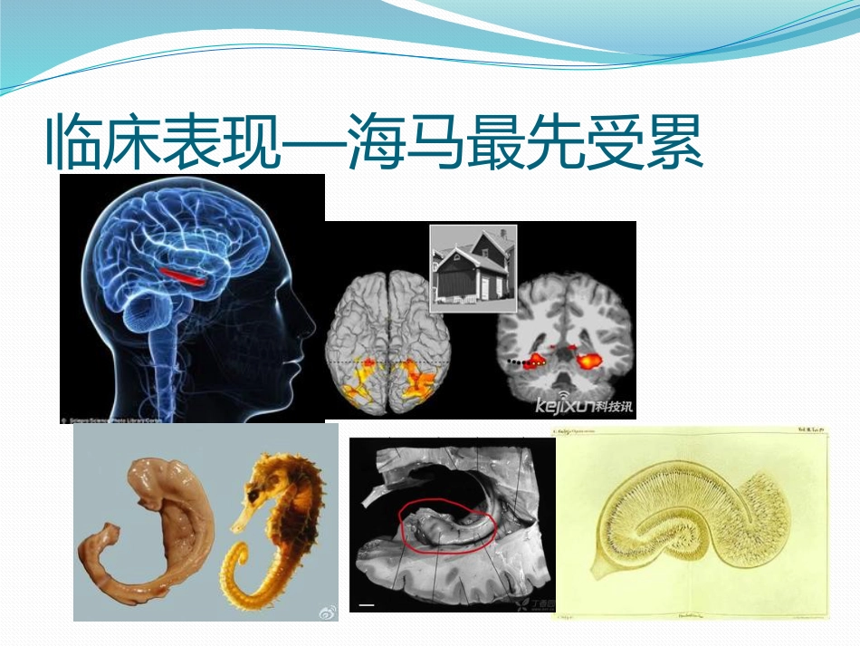 阿尔茨海默病_第10页