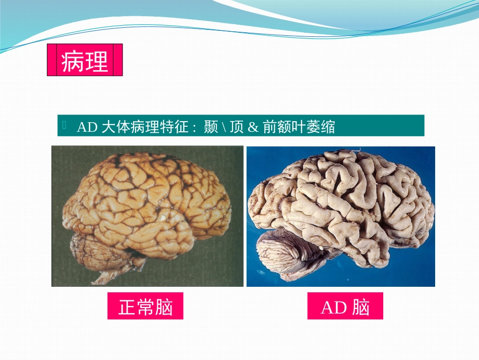 阿尔茨海默病_第5页